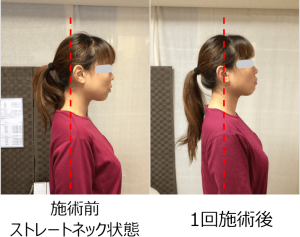 小顔矯正ストレートネック対策矯正施術例3..1